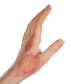 Simulated burned hand
